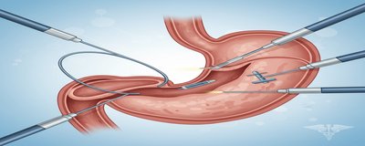 Advanced Endoscopy Procedures: EMR, ESD and Other Endoscopic Treatment Techniques