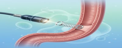 Esophageal Stenting (Esophageal Stent): Endoscopic Stenting