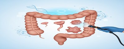 What are Colon Polyps? Polyp Symptoms and Treatment