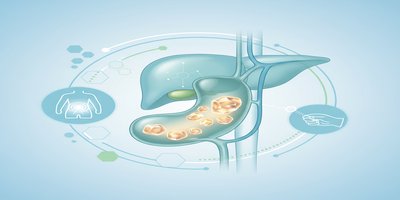 What are Gallstones? Gallstone Symptoms and Treatment