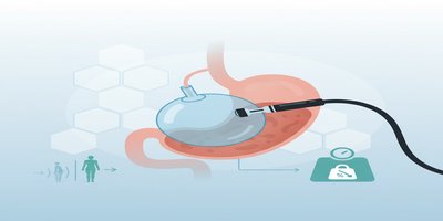 What is a Gastric Balloon? How is a Gastric Balloon Inserted? Weight Loss Method (Endoscopic Weight Loss Guide)