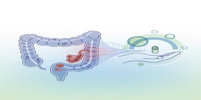 What is Colon Cancer? Colon Cancer Symptoms and Treatment