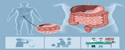 What is Colonoscopy? How is Colonoscopy Performed? Preparation Process (Step-by-Step Guide)