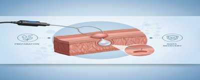 What is EMR (Endoscopic Mucosal Resection)? How to do it? Risks, Preparation and Recovery Guide