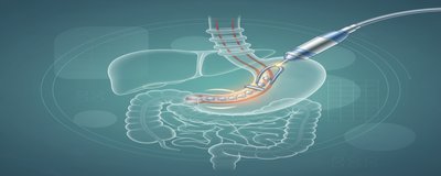 What is GERDX Reflux Treatment? Endoscopic (Non-Surgical) Reflux Treatment Method