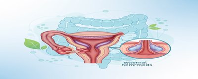 What is Hemorrhoids? Hemorrhoid Symptoms and Treatment