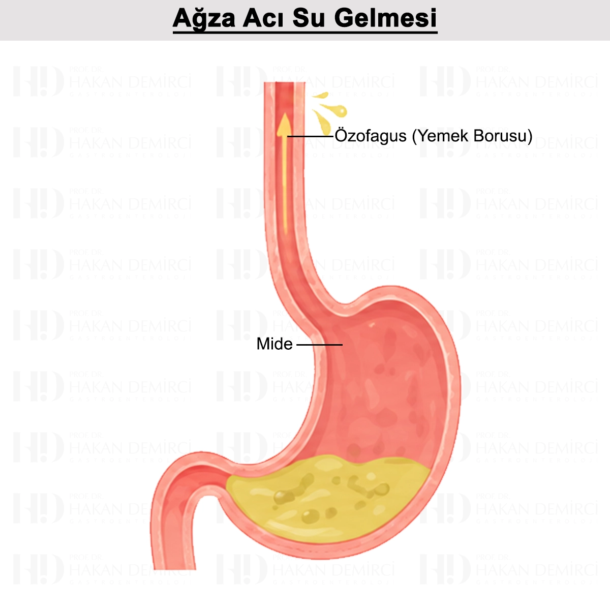 Ağıza Acı Su Gelmesi: Nedir? Nedenleri? Tetikleyicileri?