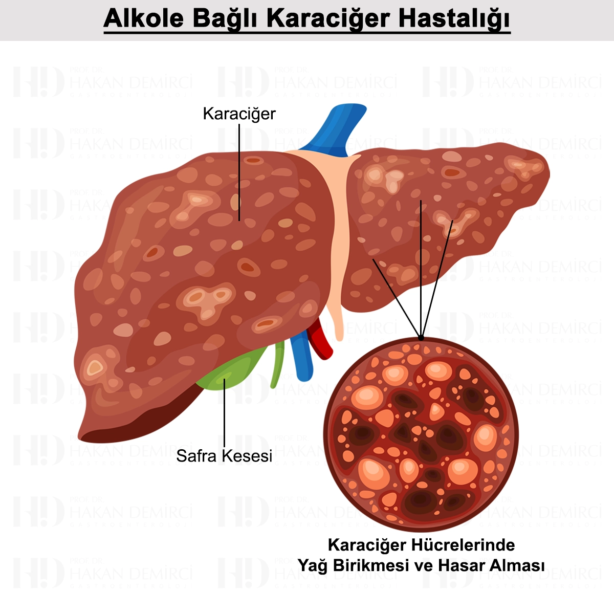Alkole Bağlı Karaciğer Hastalığı Nedir? Evreleri ve Tedavisi