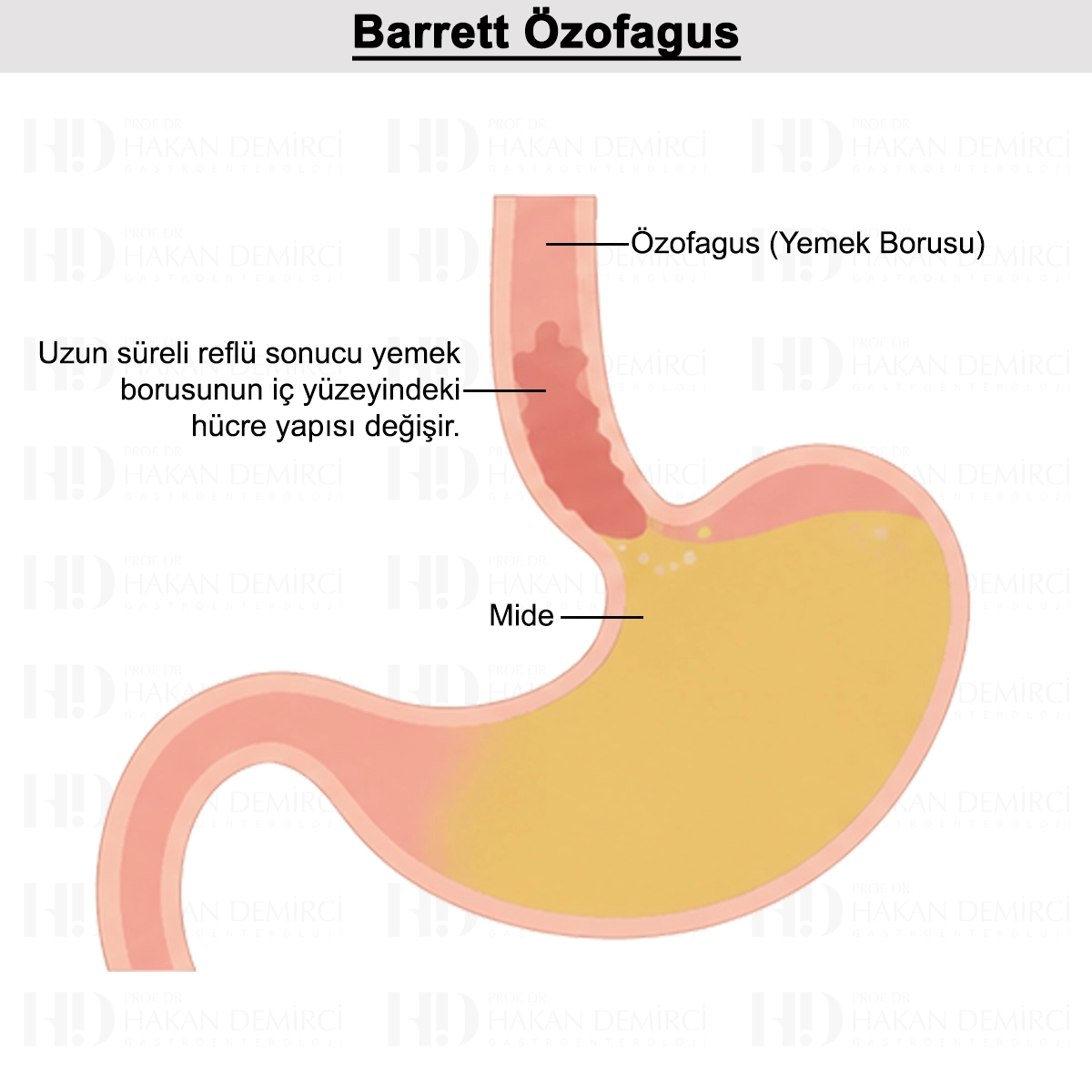 Barrett Özofagus Nedir? Belirtileri, Takibi ve Tedavisi