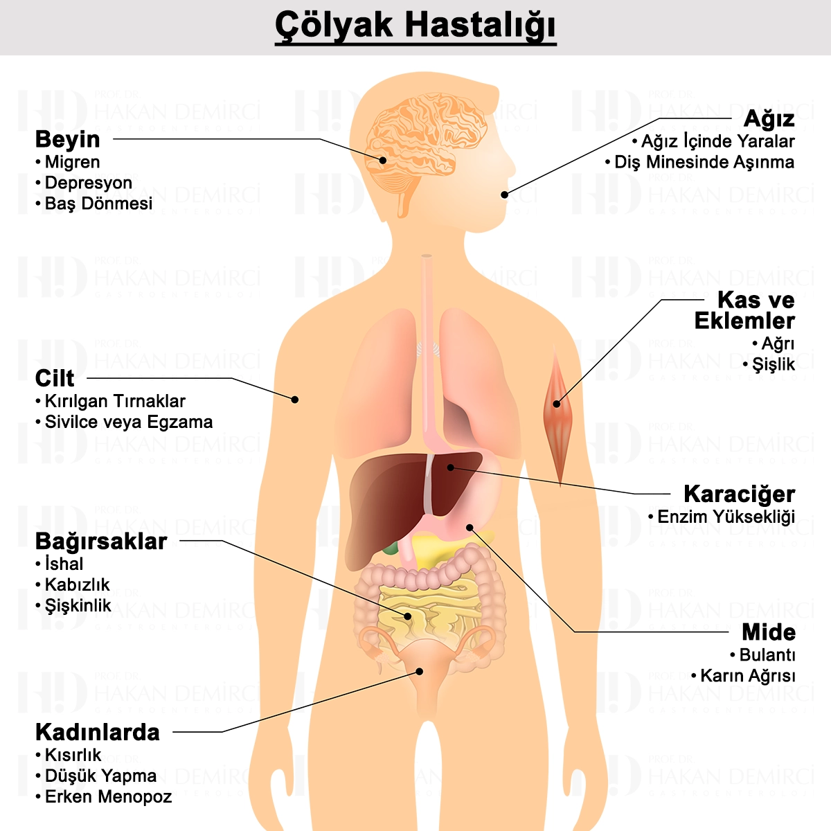 Çölyak Hastalığı Nedir? Türleri, Nedenleri ve Tedavisi
