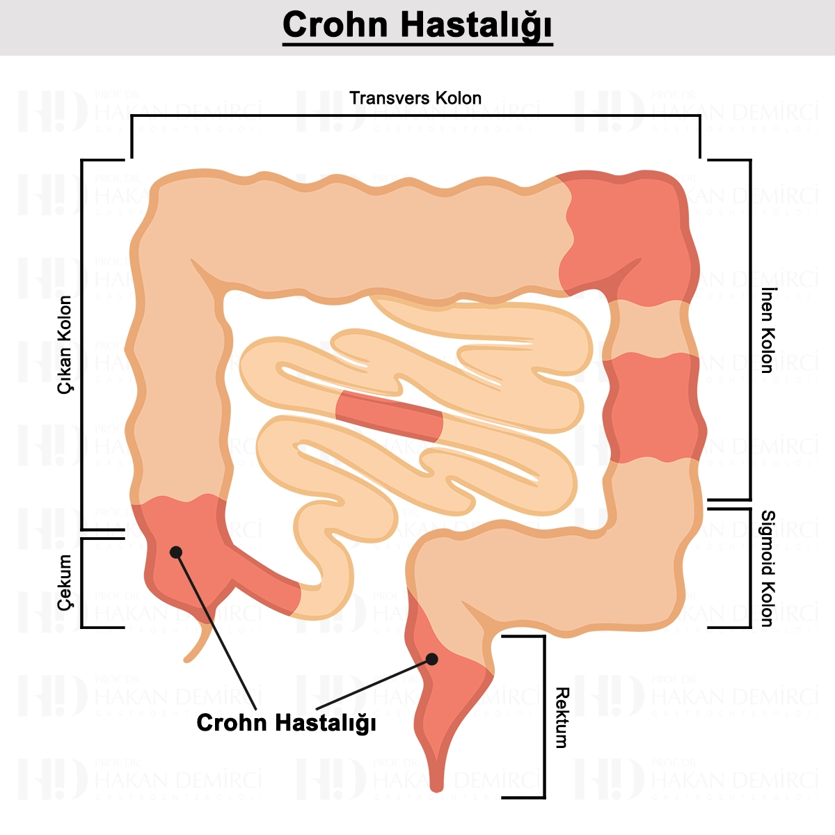 Crohn Hastalığı Nedir? Belirtileri, Tanısı ve Tedavisi