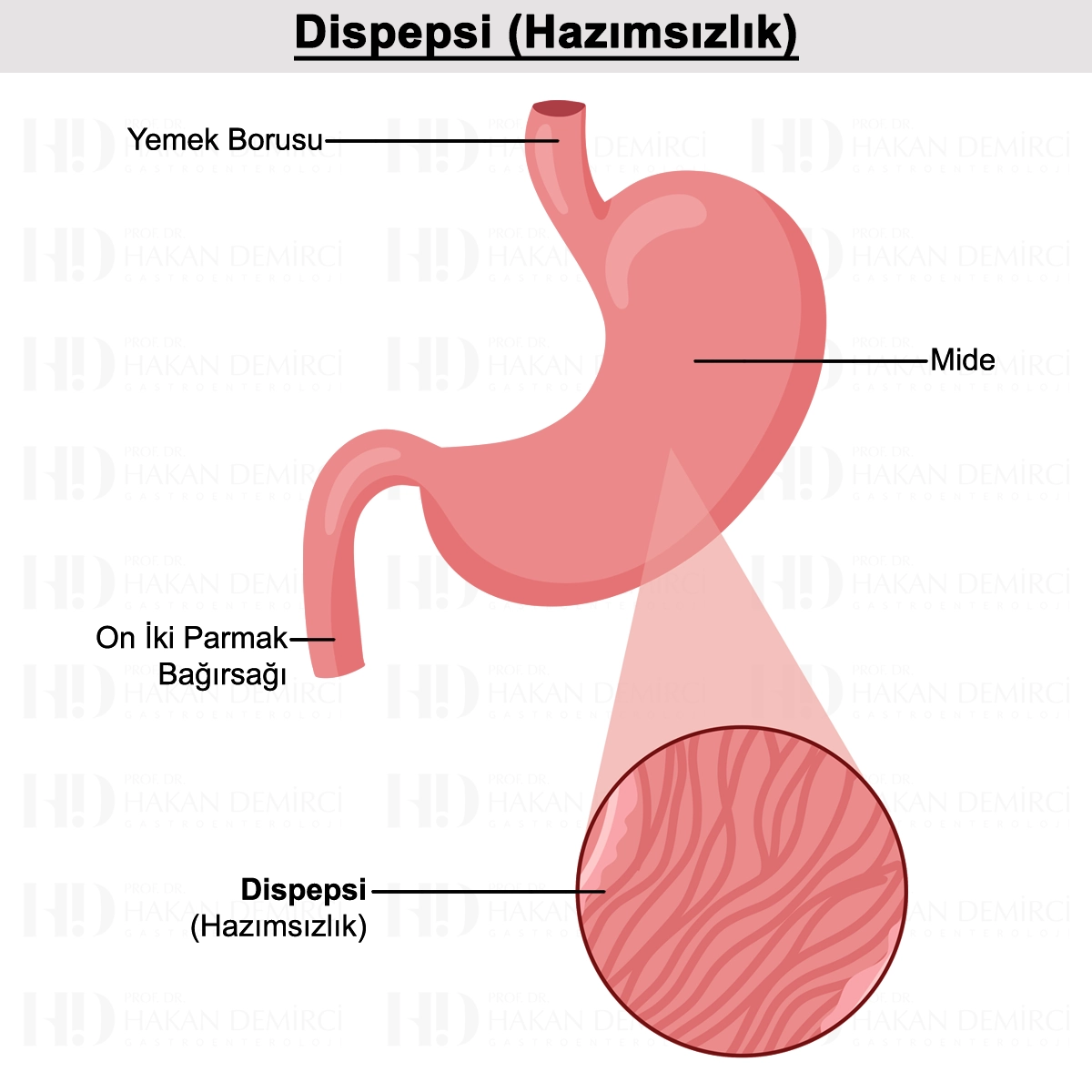 Dispepsi Nedir? Belirtileri, Nedenleri ve Tedavisi