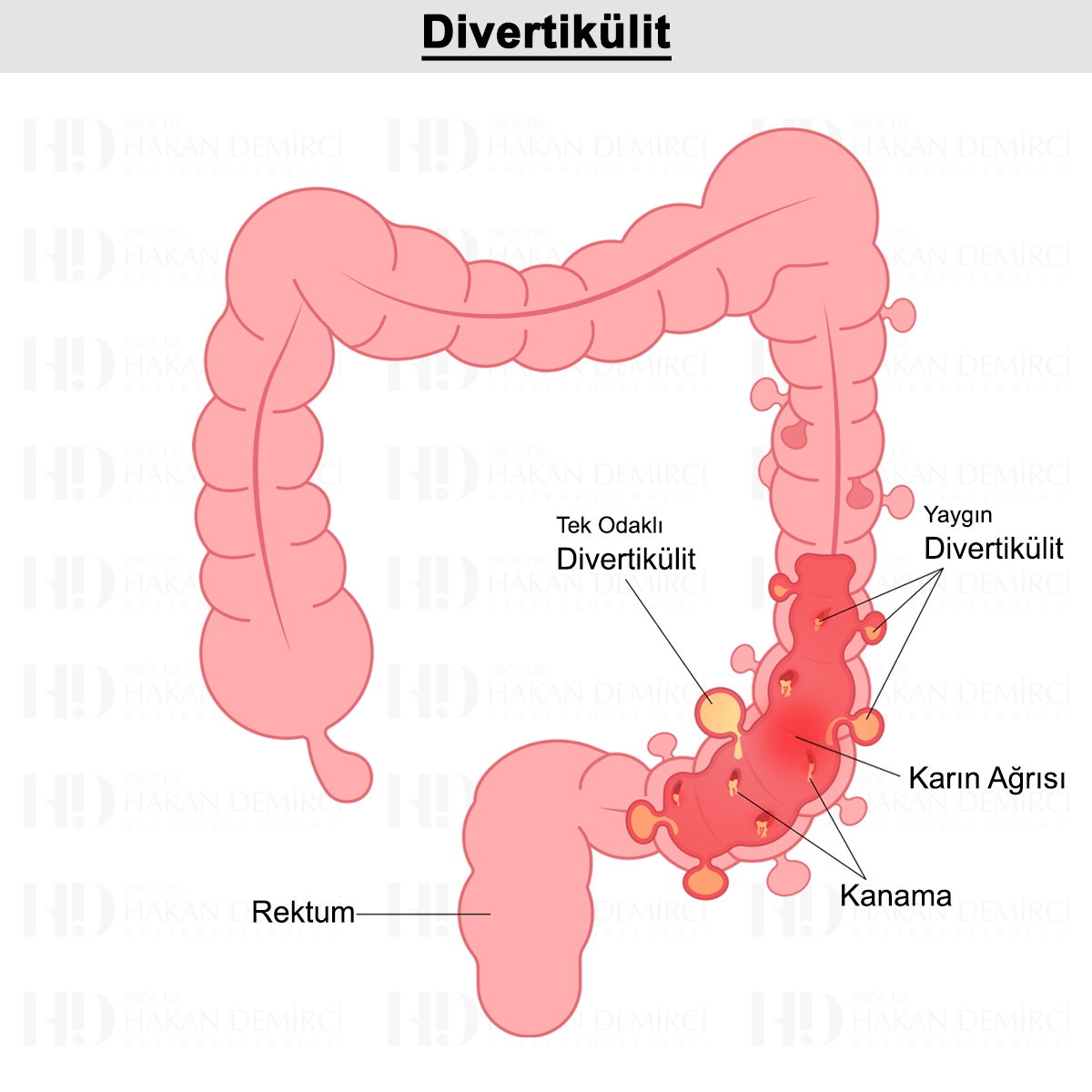 Divertikülit Nedir? Nedenleri, Belirtileri ve Tedavisi