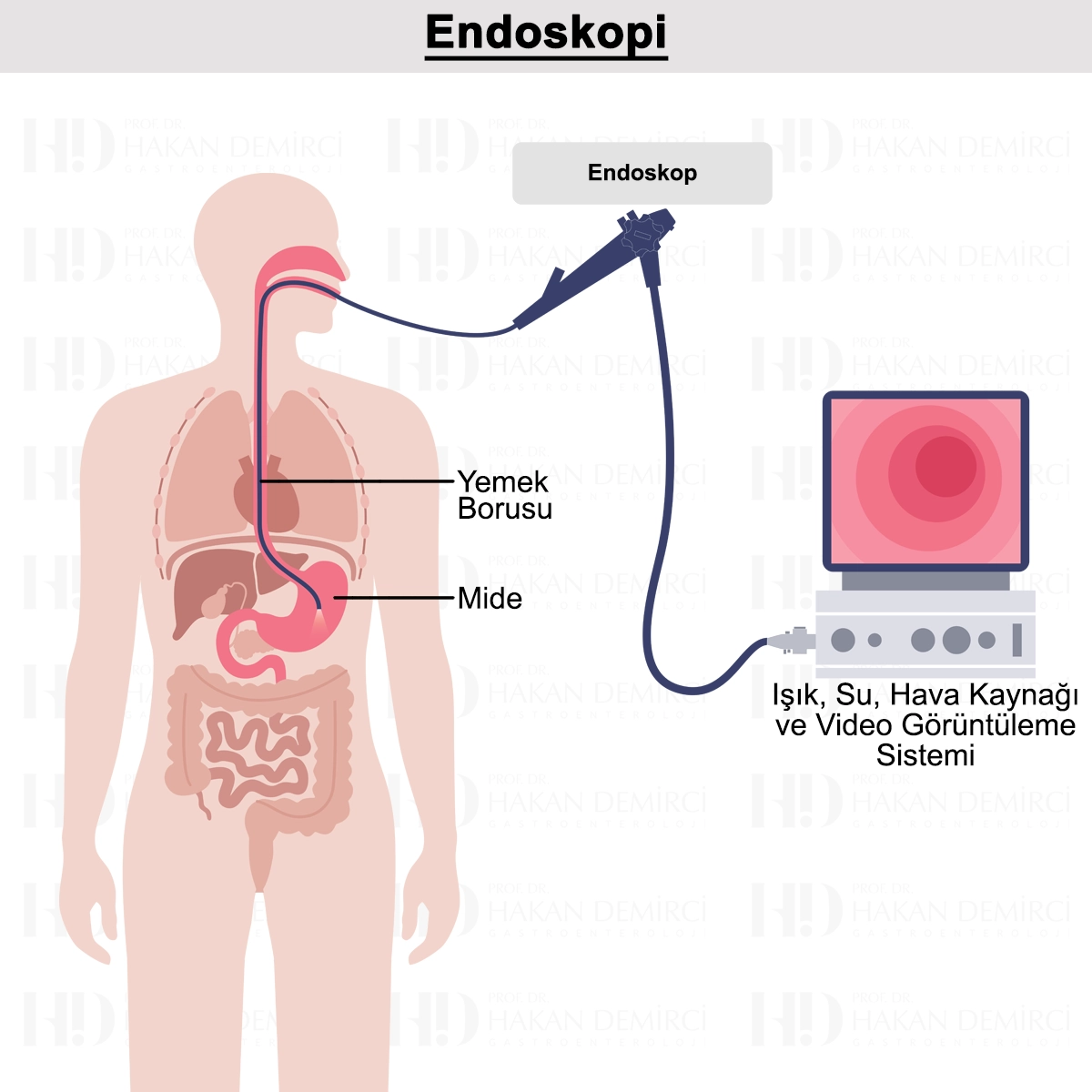 Endoskopi Nedir? Nasıl Yapılır? Öncesi ve Sonrası