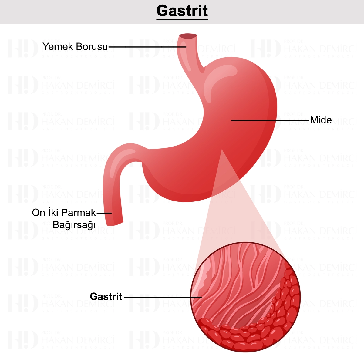 Gastrit Nedir? Nedenleri, Belirtileri, Teşhisi ve Tedavisi