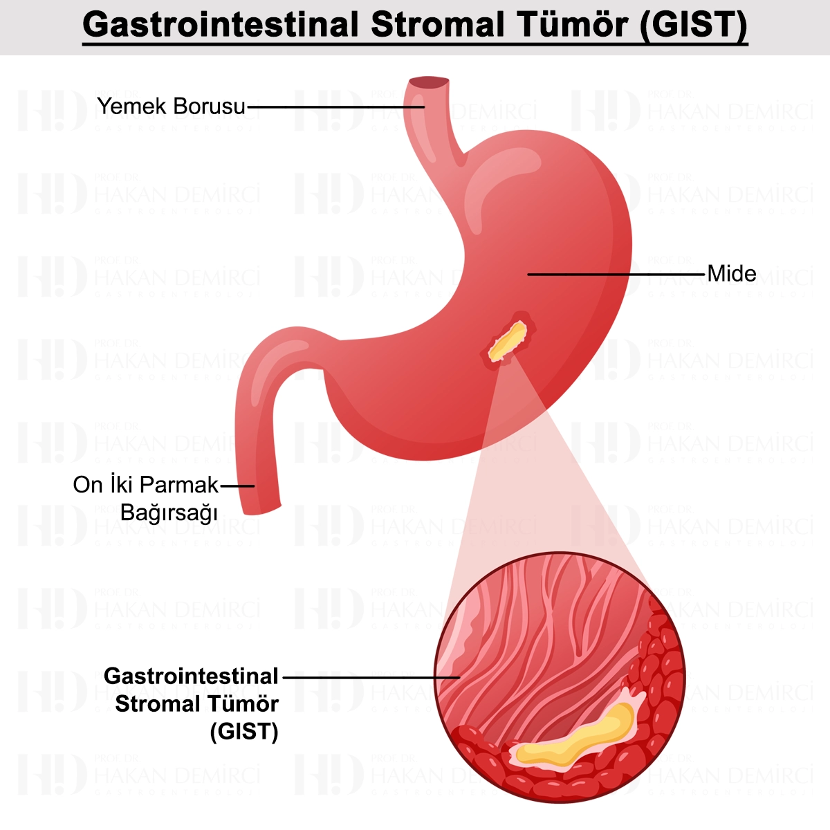 GİST (Gastrointestinal Stromal Tümör) Tanısı ve Tedavisi