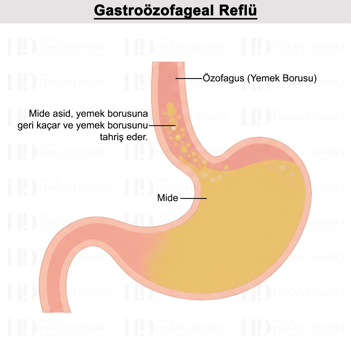Gastroözofageal Reflü Hastalığı Nedir? Nedenleri ve Tedavisi