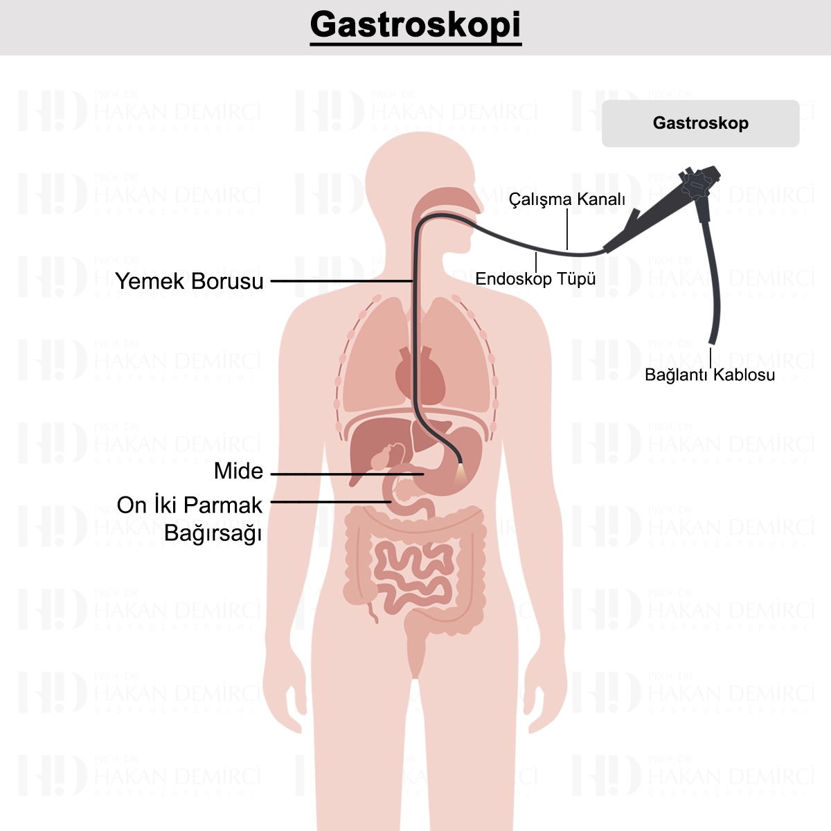 Gastroskopi Nedir? Neden Yapılır? Nasıl Uygulanır?