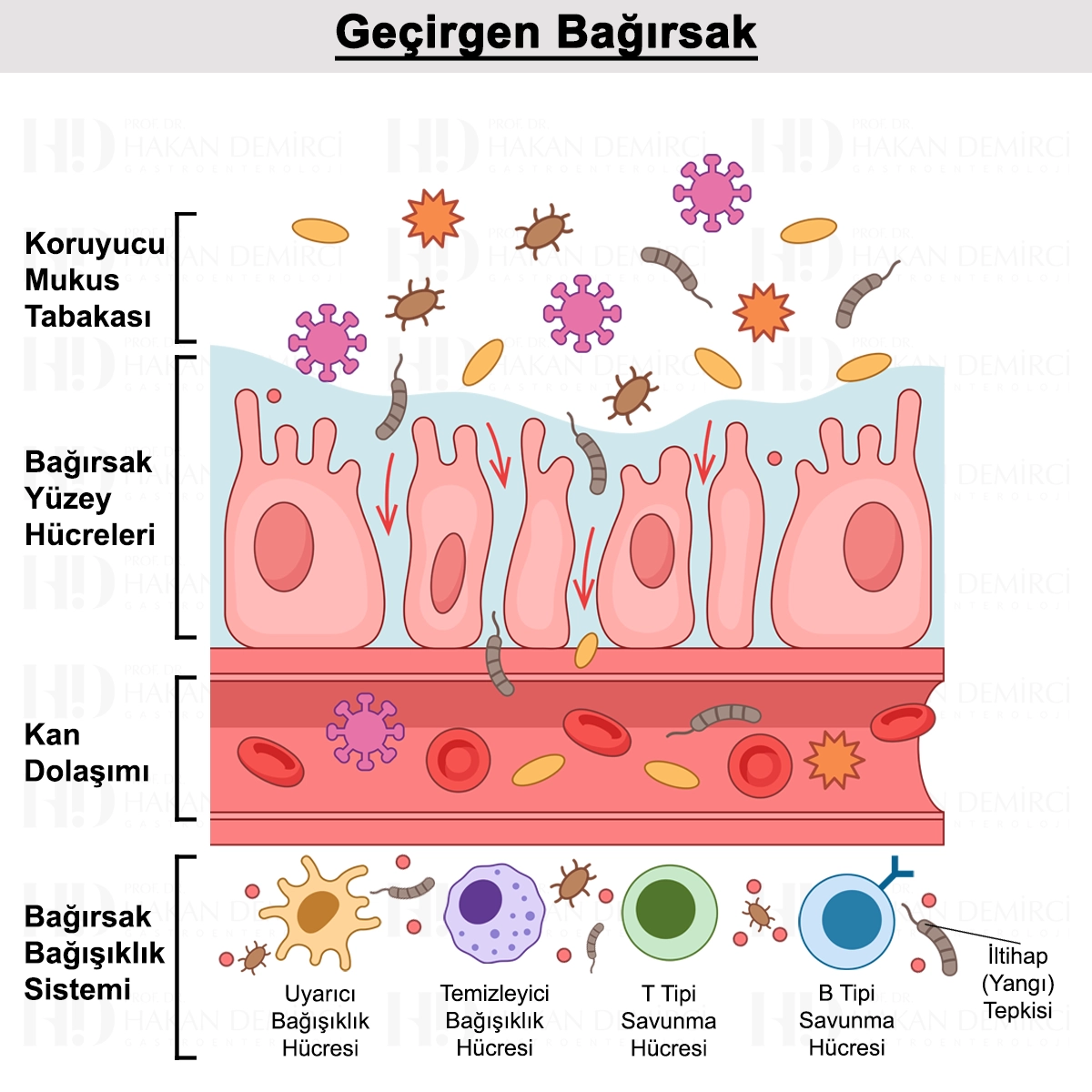 Geçirgen Bağırsak Sendromu Nedir? Tanısı ve Tedavisi