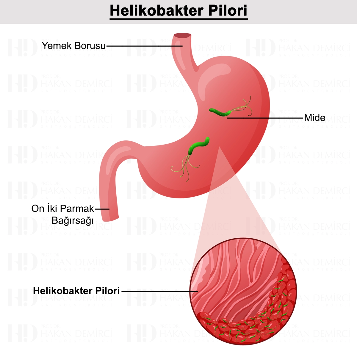 Helikobakter Pilori Nedir? Belirtileri, Teşhisi ve Tedavisi