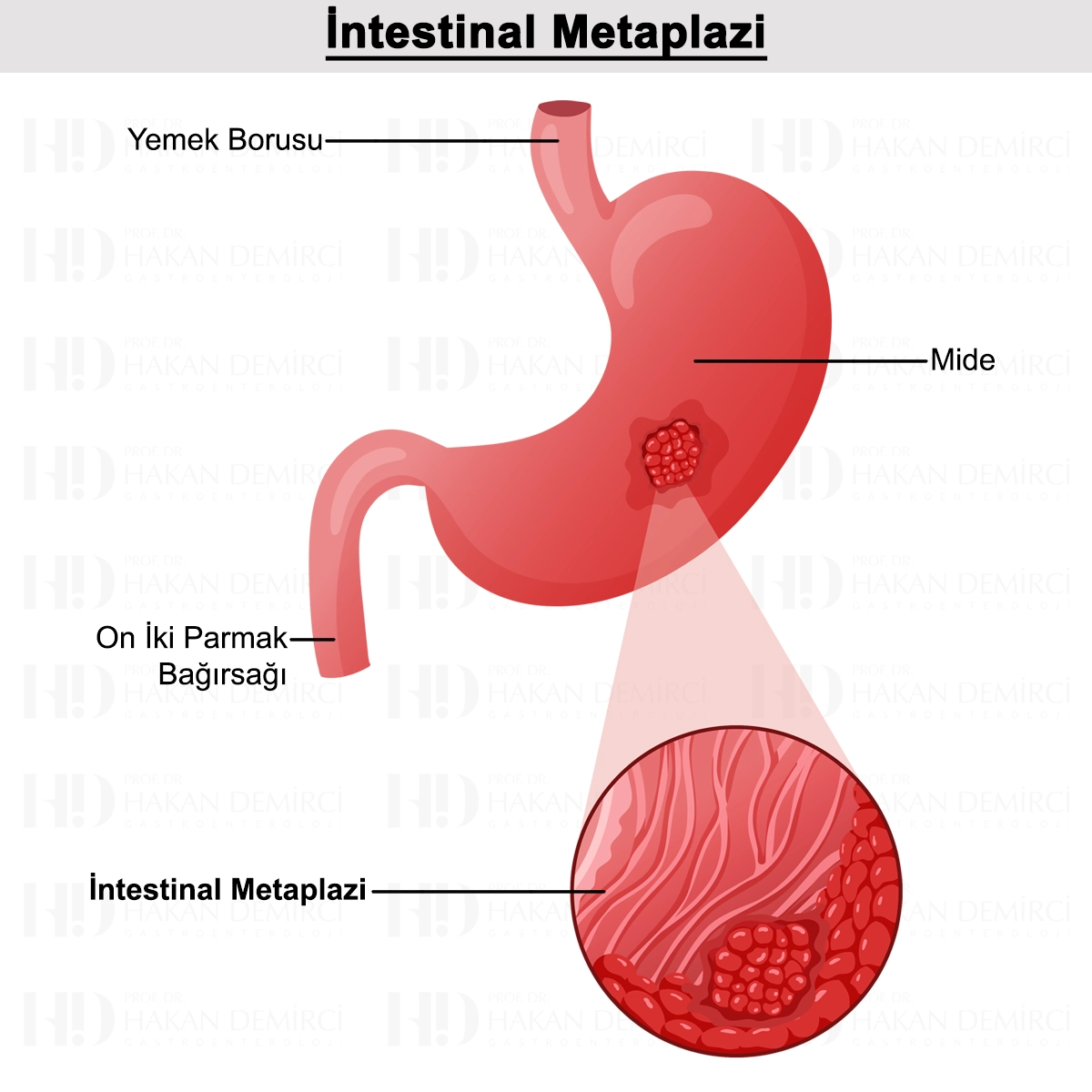 İntestinal Metaplazi Nedir? Belirtileri ve Tedavisi