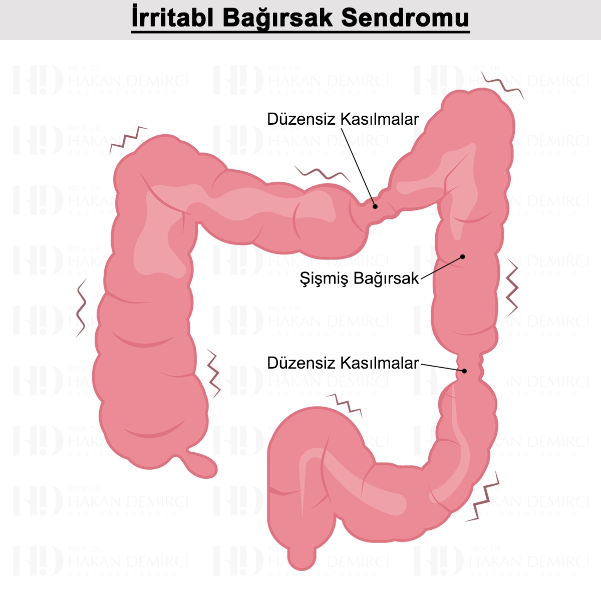 İrritabl Bağırsak Sendromu Nedir? Belirtileri ve Tedavisi