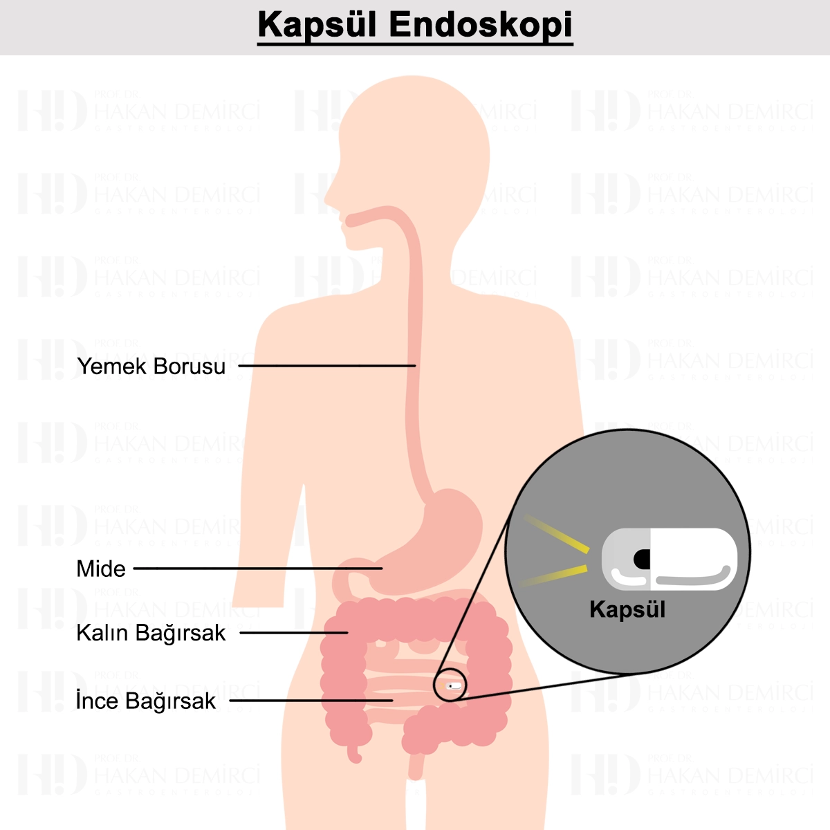 Kapsül Endoskopi Nedir? Nasıl Yapılır? Fiyatı?