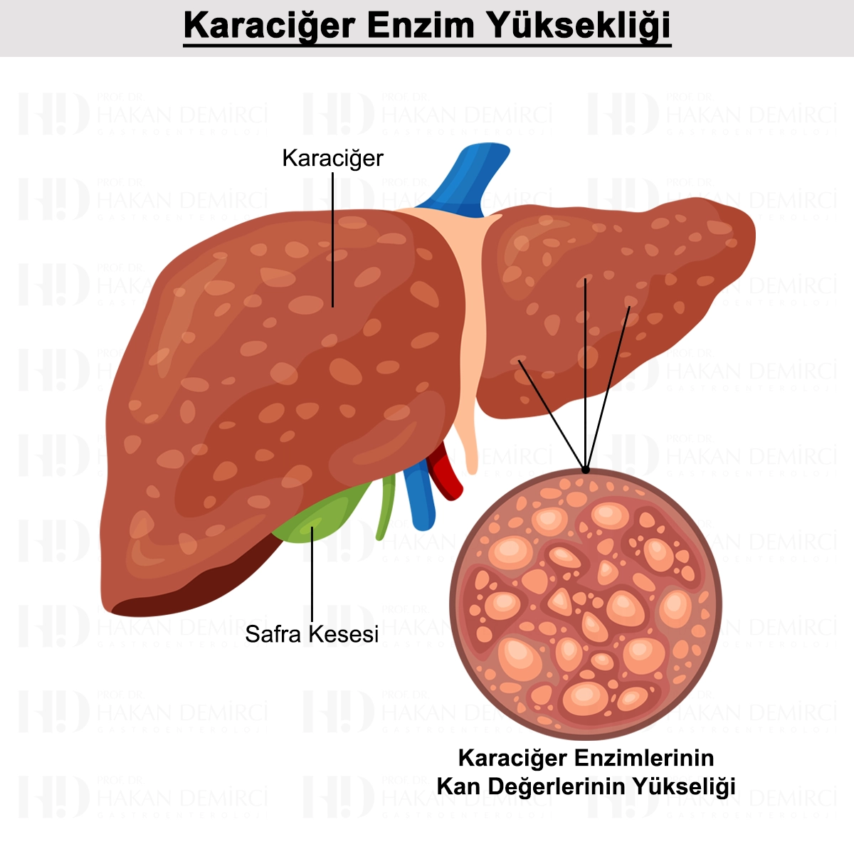 Karaciğer Enzim Yüksekliği Nedir? Testleri ve Tedavisi