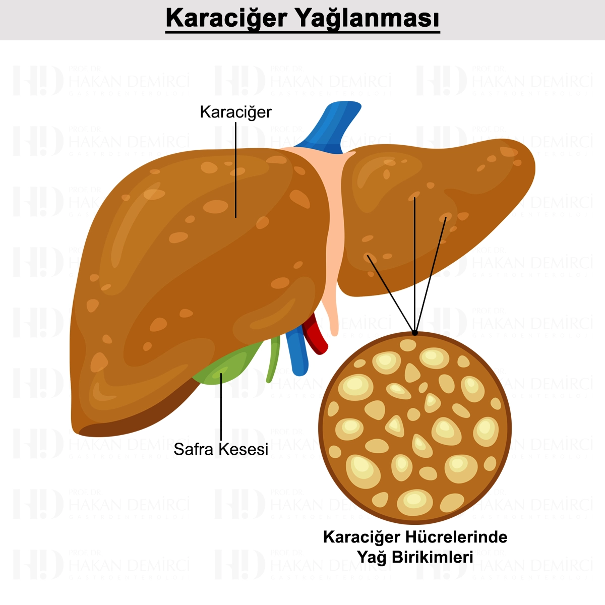 Karaciğer Yağlanması Nedir? Belirtileri, Tanısı ve Tedavisi