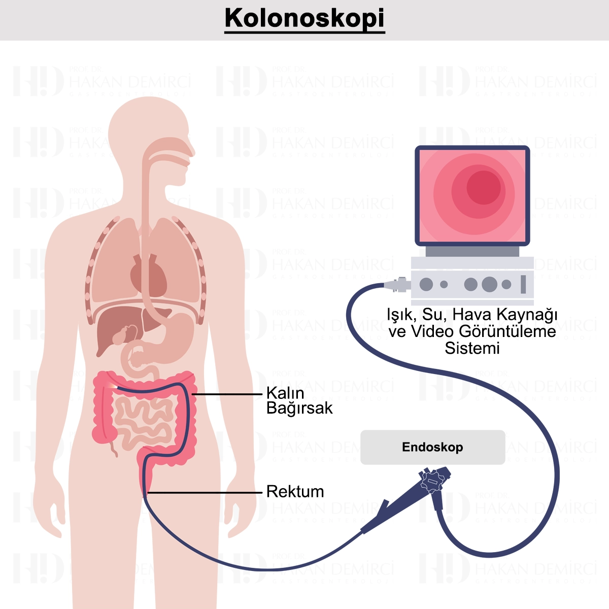 Ağrısız Kolonoskopi Nedir? Öncesi, Sonrası ve Fiyatı