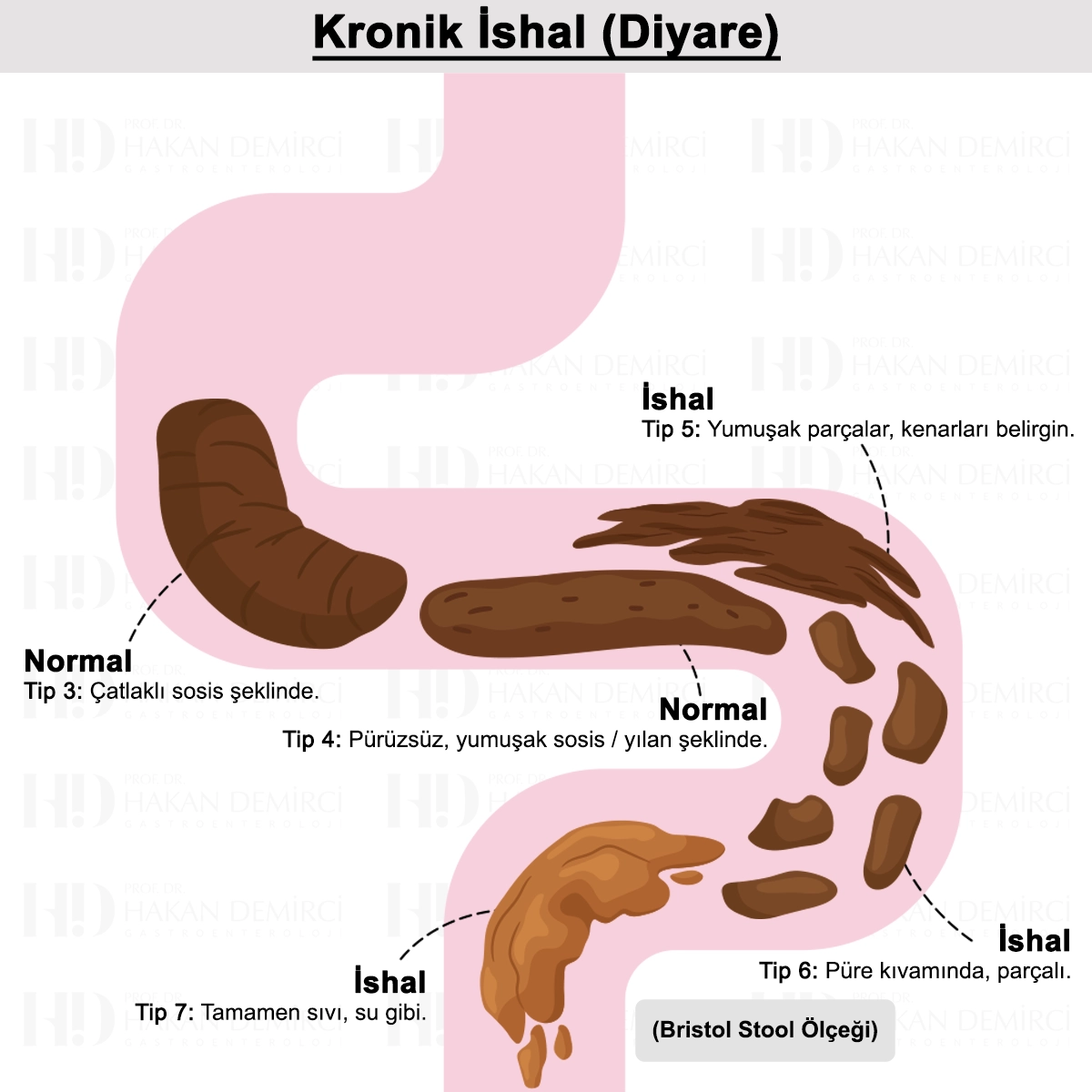 Kronik İshal Nedir? Belirtileri, Nedenleri ve Tedavisi