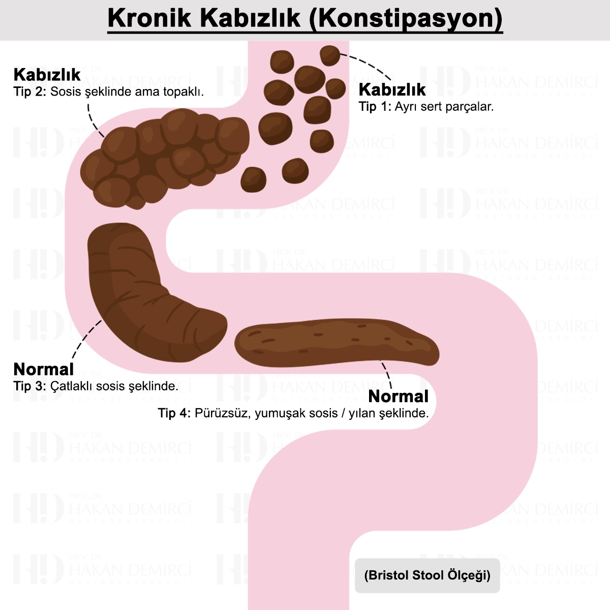 Kronik Kabızlık Nedir? Belirtileri, Nedenleri ve Tedavisi
