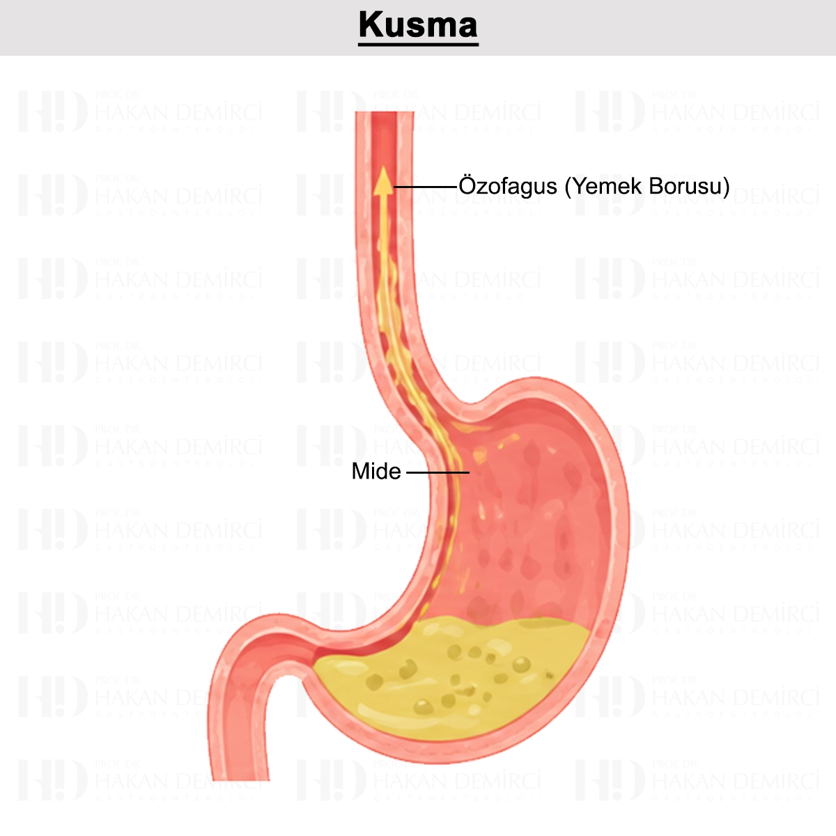 Kusma Nedir? Nedenleri? Ne İyi Gelir? Ne Yapılmalı?