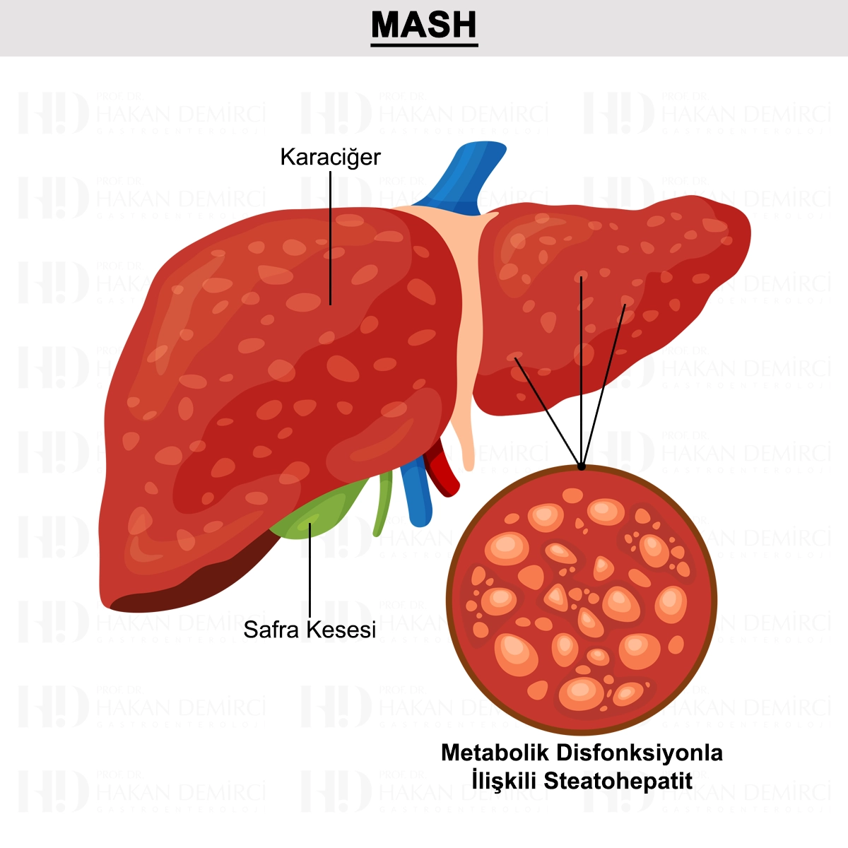 MASH (Metabolik Disfonksiyonla İlişkili Steatohepatit)