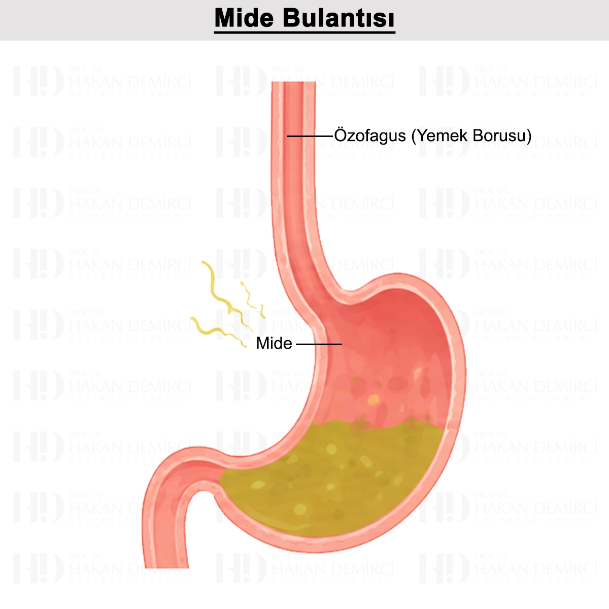Mide Bulantısı: Nedir? Ne İyi Gelir? Nasıl Geçer?