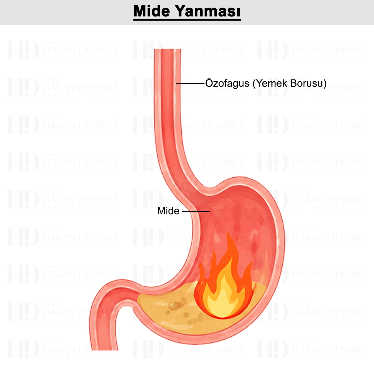 Mide Yanması: Nedir? Nedenleri? Ne İyi Gelir? Tedavisi?