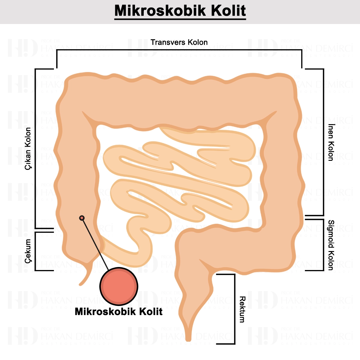 Mikroskobik Kolit Nedir? Belirtileri, Tanısı ve Tedavisi