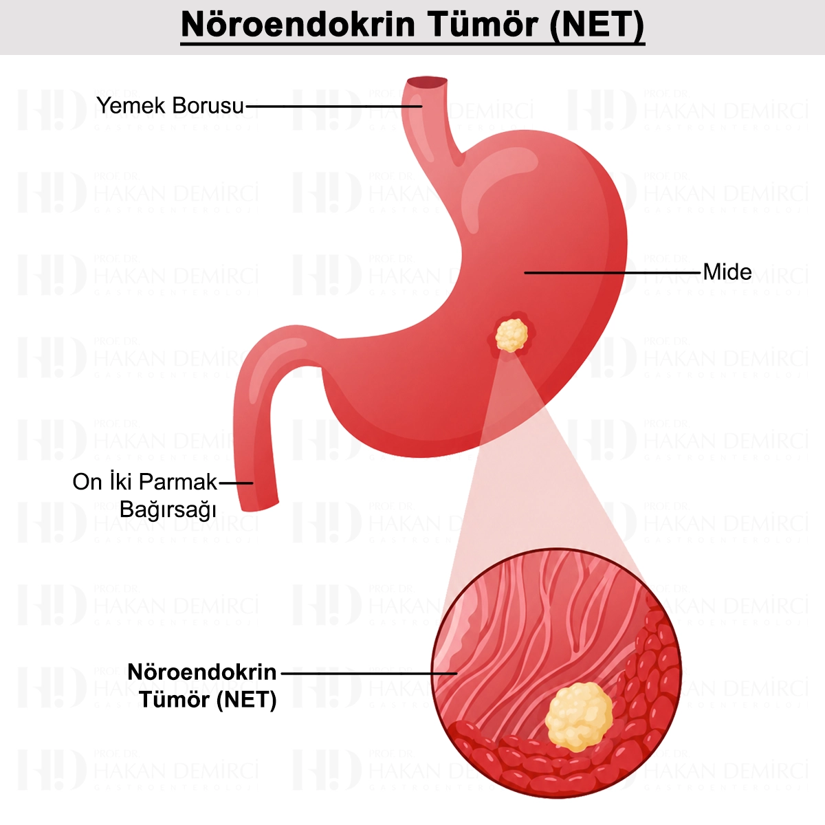 NET (Nöroendokrin Tümör) Nedir? Evreleri ve Tedavisi