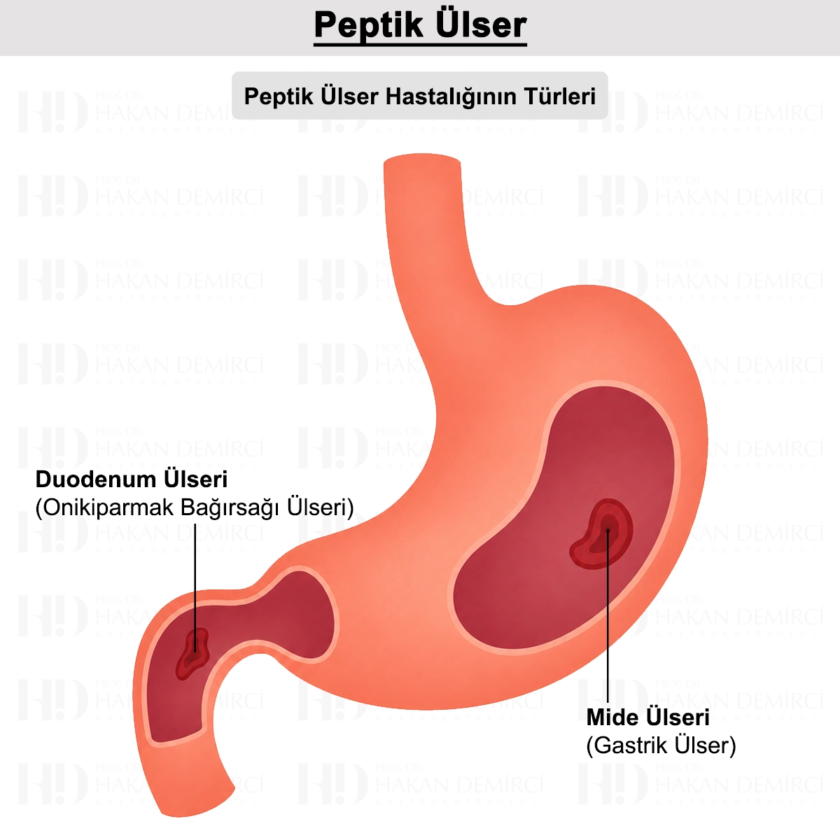 Peptik Ülser: Nedir? Nedenleri, Belirtileri ve Tedavisi