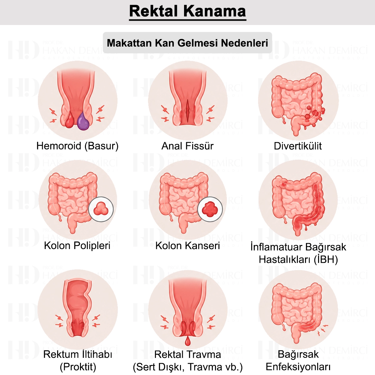 Rektal Kanama: Nedir? Belirtileri, Tanısı ve Tedavisi