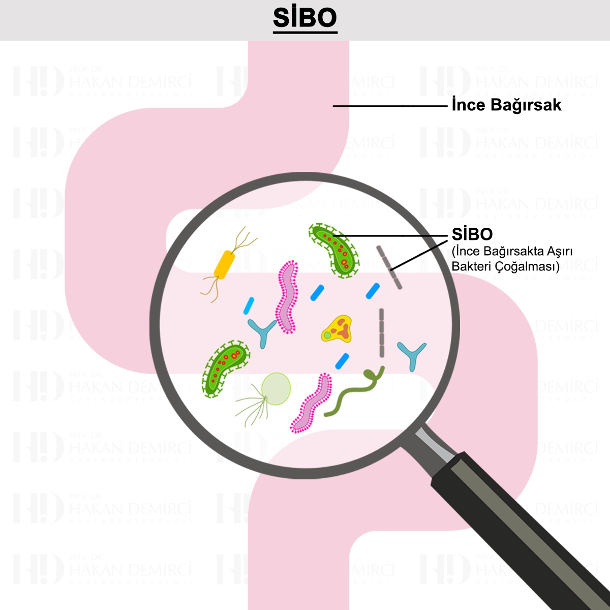SİBO Nedir? Belirtileri, Tanısı, Testi ve Tedavisi